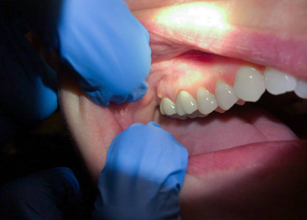 Best Emergency Root Canal Treatment in Frankfort, IN