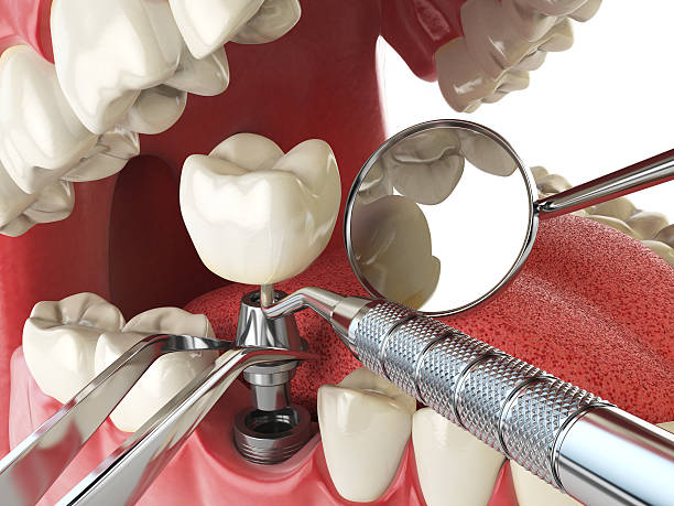 Best Broken or Cracked Tooth Emergency Dentist in Frankfort, IN