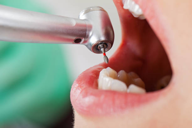 Best Emergency Dental Extractions in Frankfort, IN